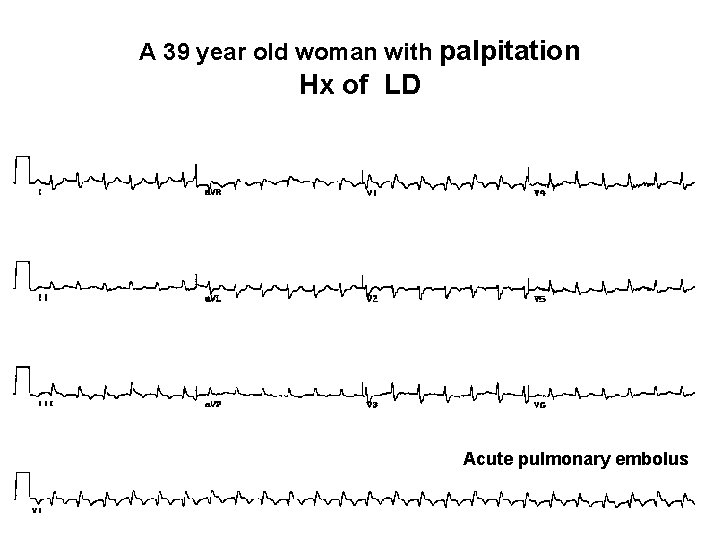 A 39 year old woman with palpitation Hx of LD Acute pulmonary embolus 