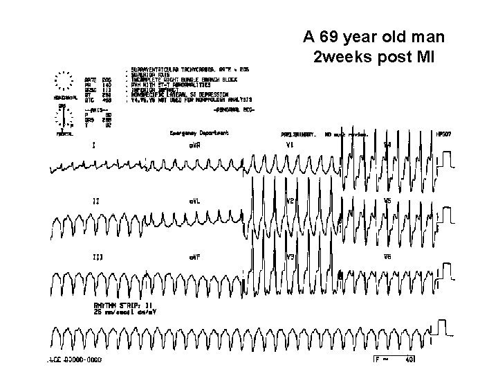 A 69 year old man 2 weeks post MI 