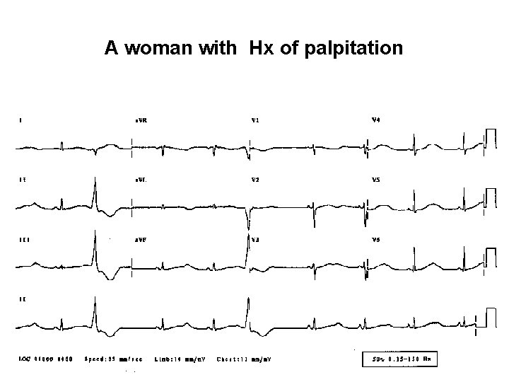 A woman with Hx of palpitation 