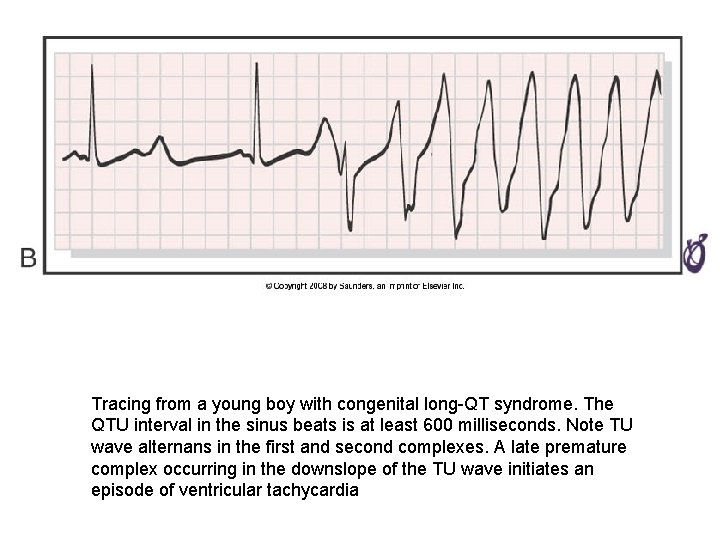 Tracing from a young boy with congenital long-QT syndrome. The QTU interval in the