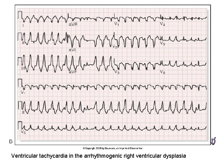 Ventricular tachycardia in the arrhythmogenic right ventricular dysplasia 