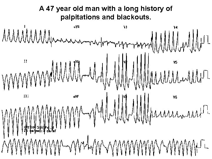 A 47 year old man with a long history of palpitations and blackouts. 