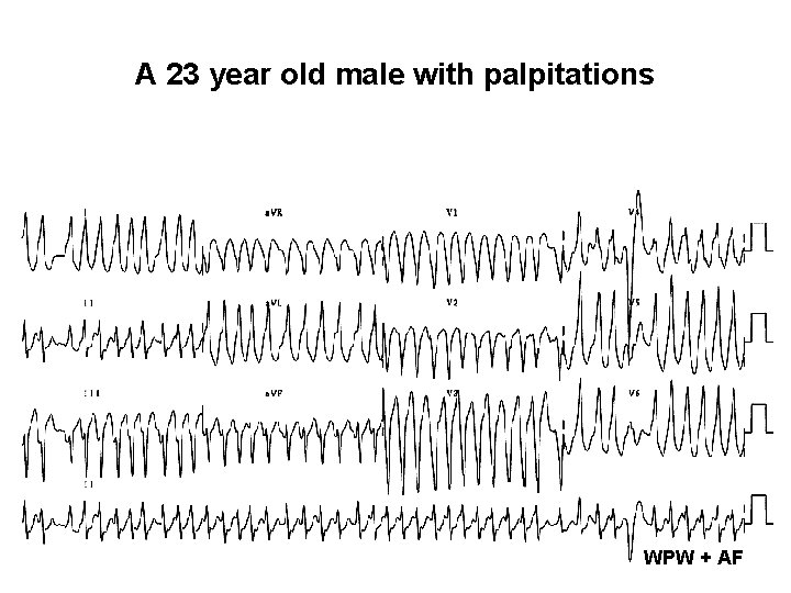 A 23 year old male with palpitations WPW + AF 