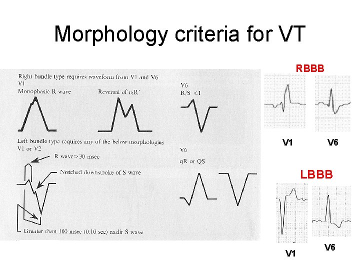 Morphology criteria for VT RBBB V 1 V 6 LBBB V 1 V 6