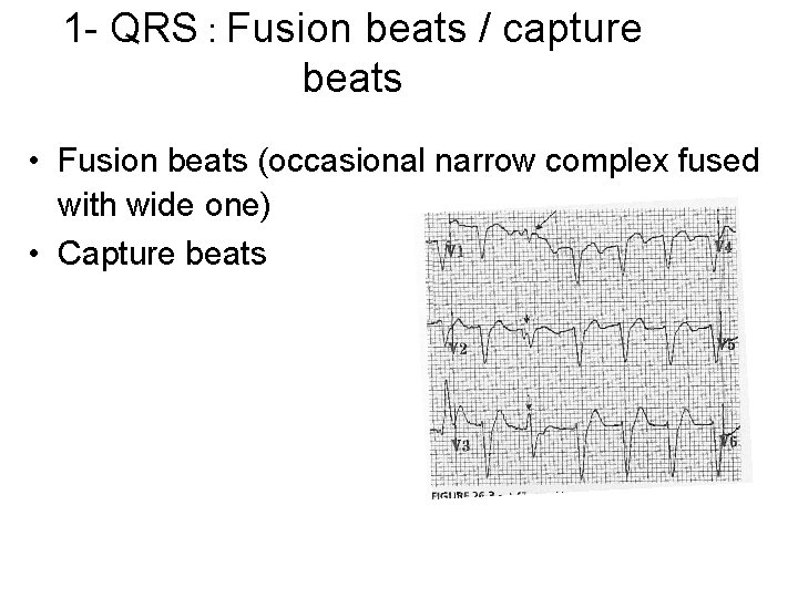 1 - QRS : Fusion beats / capture beats • Fusion beats (occasional narrow