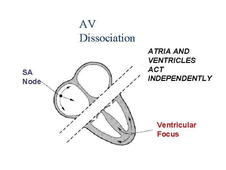 AV Dissociation SA Node ATRIA AND VENTRICLES ACT INDEPENDENTLY Ventricular Focus 