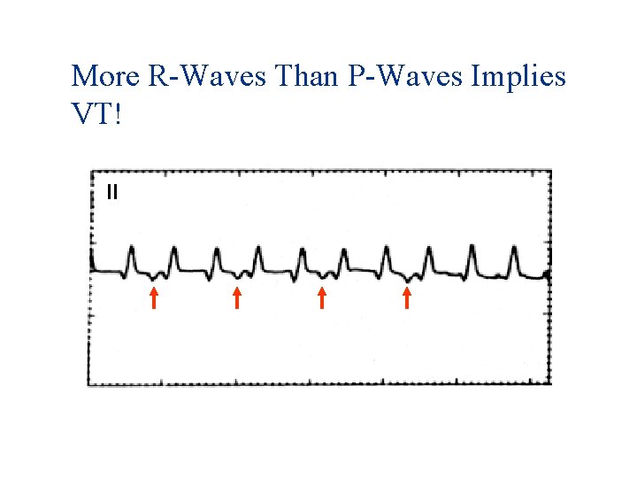 More R-Waves Than P-Waves Implies VT! II 