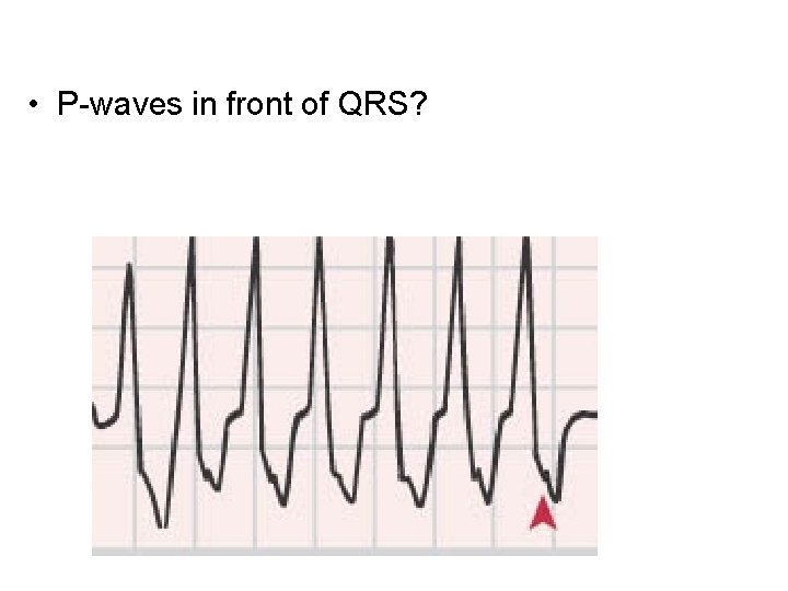  • P-waves in front of QRS? 