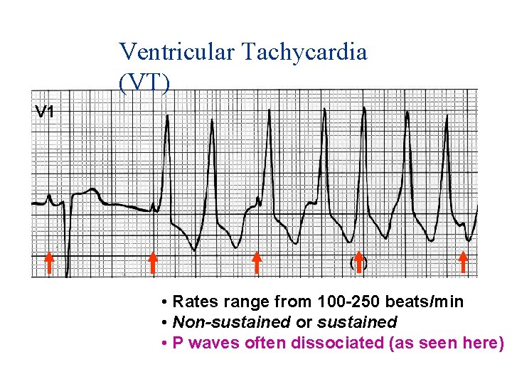 Ventricular Tachycardia (VT) V 1 • Rates range from 100 -250 beats/min • Non-sustained