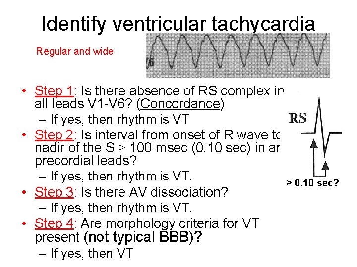 Identify ventricular tachycardia Regular and wide • Step 1: Is there absence of RS
