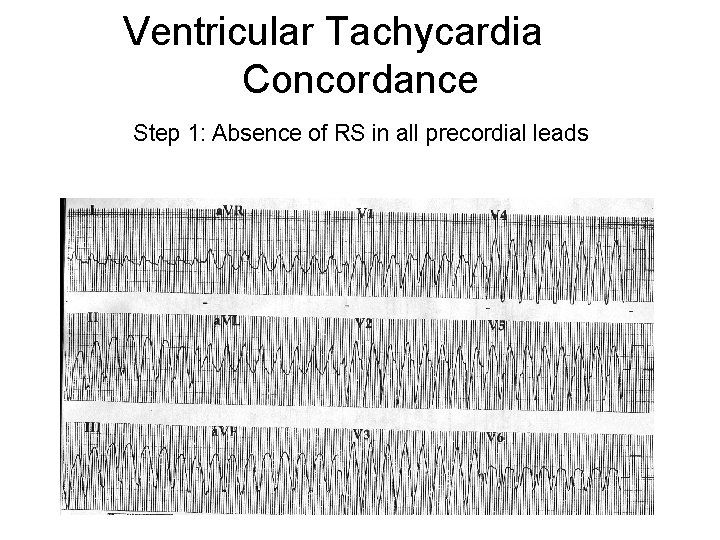 Ventricular Tachycardia Concordance Step 1: Absence of RS in all precordial leads 