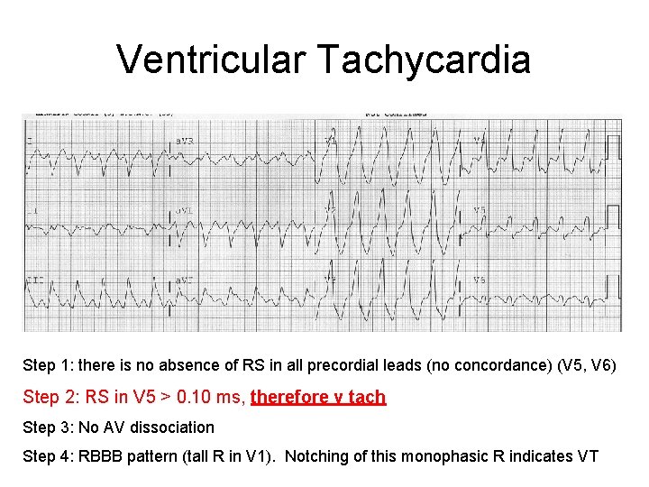 Ventricular Tachycardia Step 1: there is no absence of RS in all precordial leads