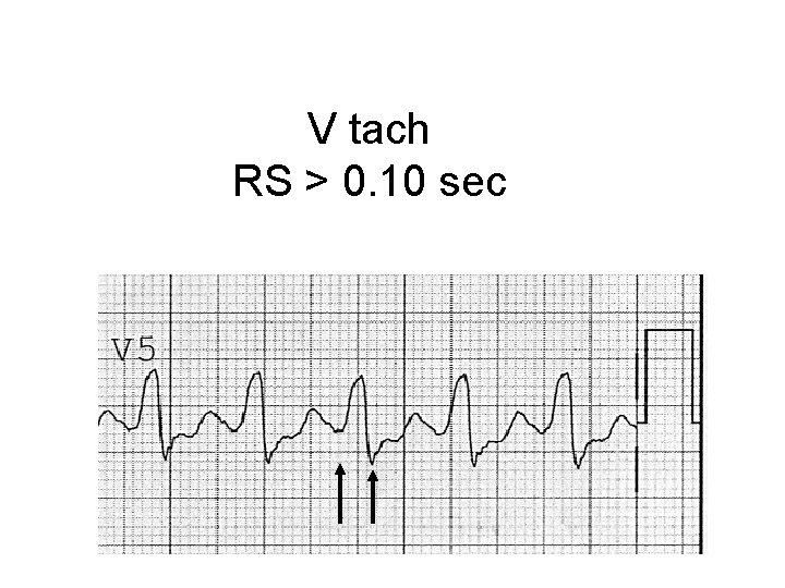 V tach RS > 0. 10 sec 