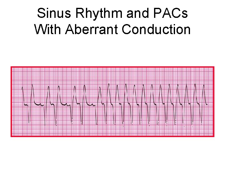 Sinus Rhythm and PACs With Aberrant Conduction 