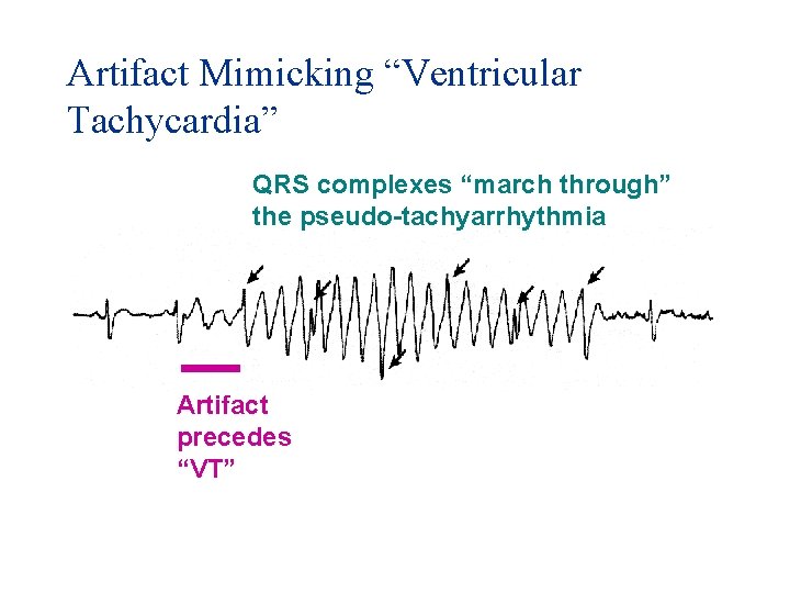 Artifact Mimicking “Ventricular Tachycardia” QRS complexes “march through” the pseudo-tachyarrhythmia Artifact precedes “VT” 
