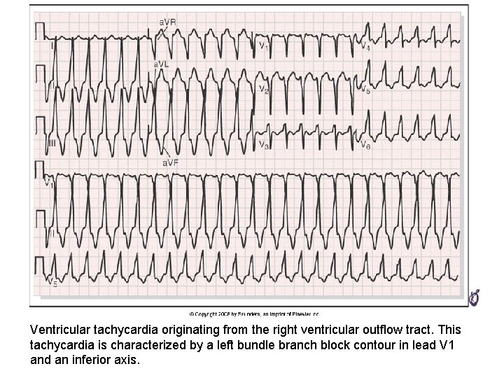 Ventricular tachycardia originating from the right ventricular outflow tract. This tachycardia is characterized by