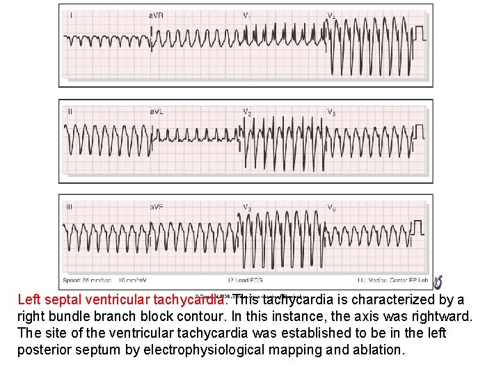 Left septal ventricular tachycardia. This tachycardia is characterized by a right bundle branch block