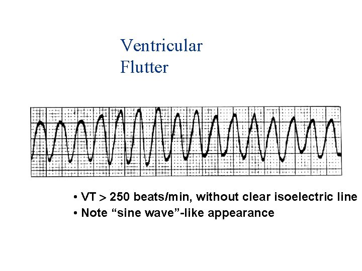 Ventricular Flutter • VT 250 beats/min, without clear isoelectric line • Note “sine wave”-like