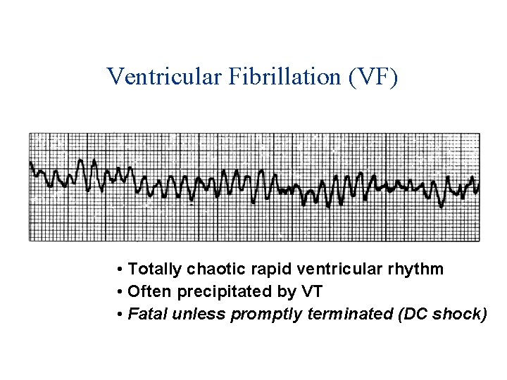Ventricular Fibrillation (VF) • Totally chaotic rapid ventricular rhythm • Often precipitated by VT