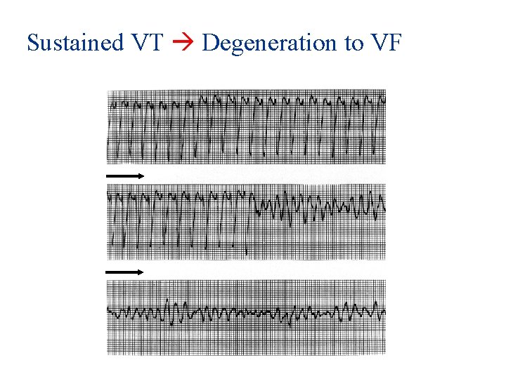 Sustained VT Degeneration to VF 