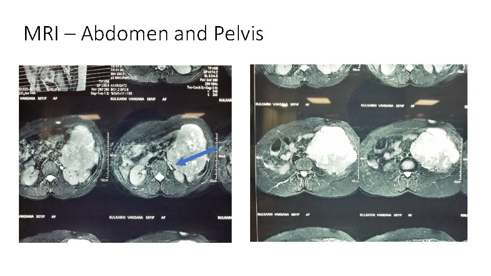 MRI – Abdomen and Pelvis 
