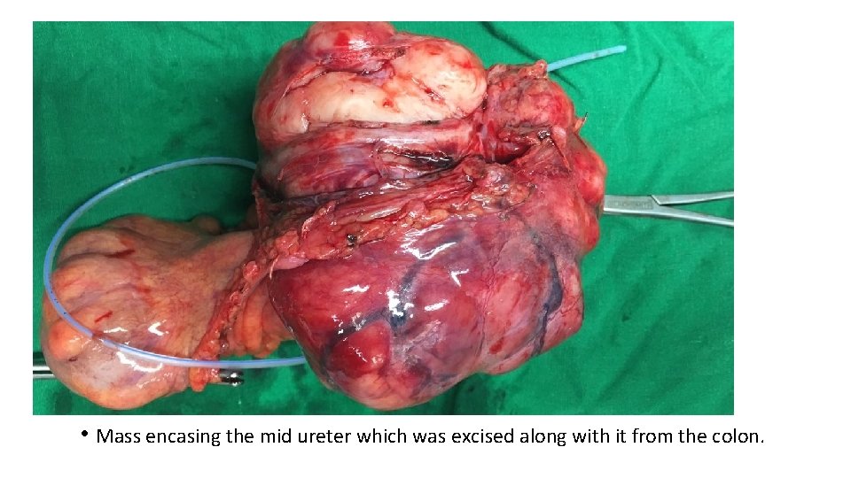  • Mass encasing the mid ureter which was excised along with it from