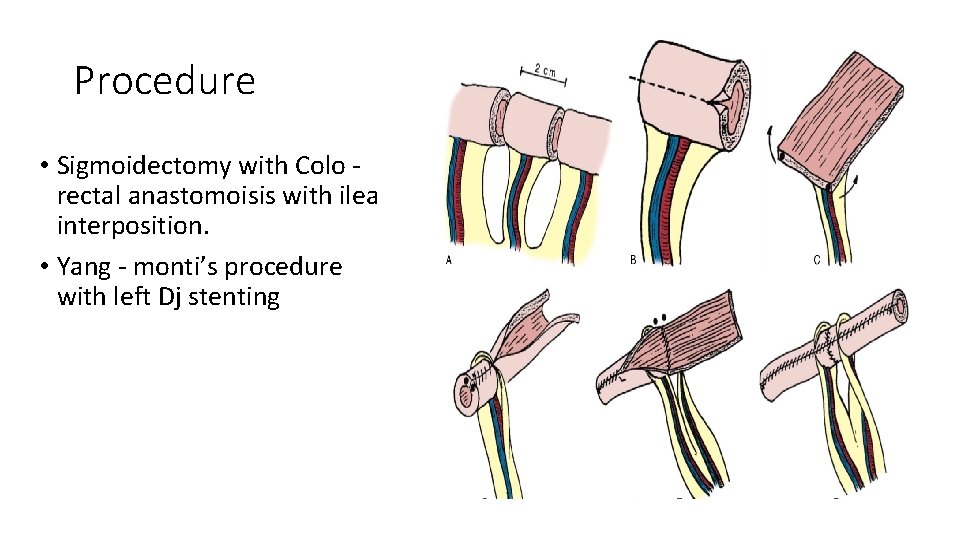 Procedure • Sigmoidectomy with Colo rectal anastomoisis with ileal interposition. • Yang - monti’s