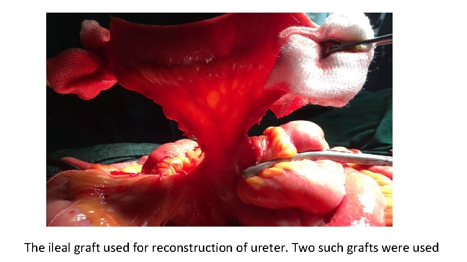 The ileal graft used for reconstruction of ureter. Two such grafts were used 