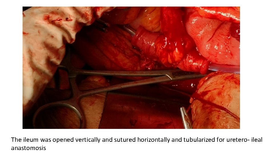 The ileum was opened vertically and sutured horizontally and tubularized for uretero- ileal anastomosis