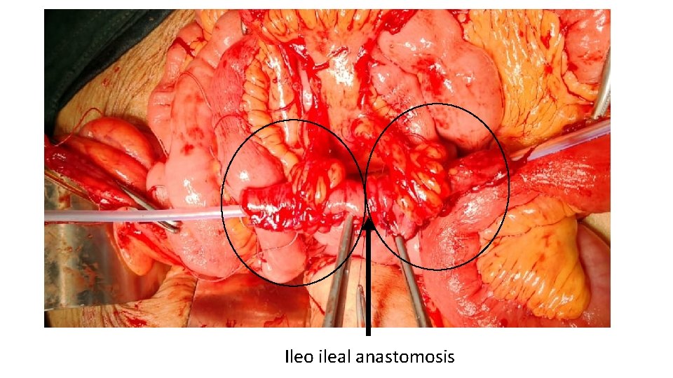 Ileo ileal anastomosis 