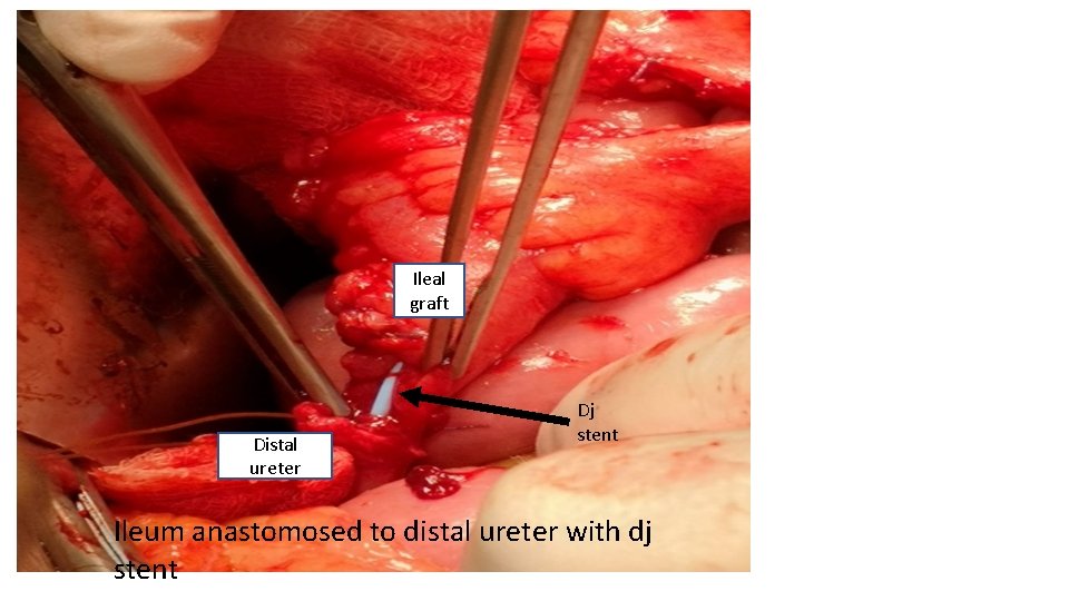 Ileal graft Distal ureter Dj stent Ileum anastomosed to distal ureter with dj stent