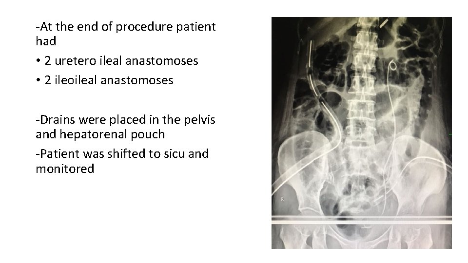 -At the end of procedure patient had • 2 uretero ileal anastomoses • 2