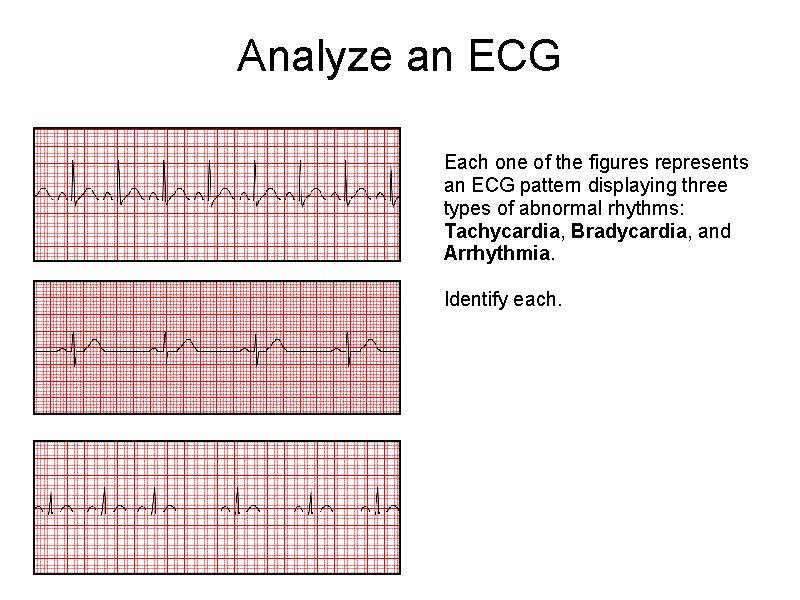 Analyze an ECG Each one of the figures represents an ECG pattern displaying three