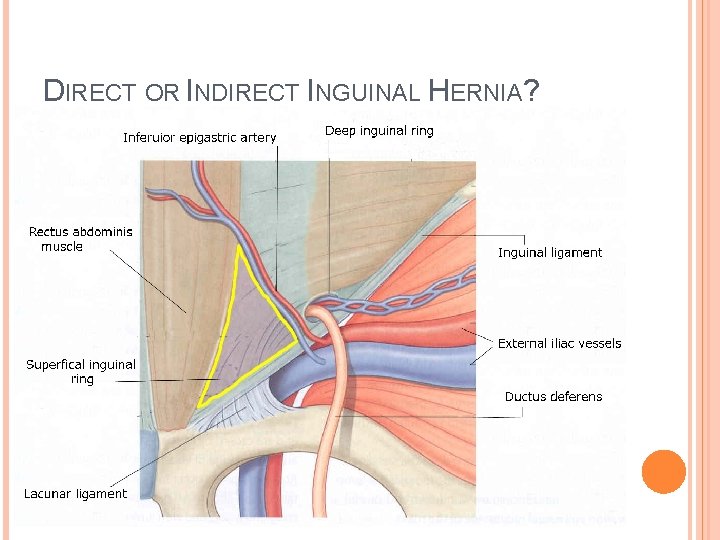 DIRECT OR INDIRECT INGUINAL HERNIA? Almost pointless clinically to distinguish. . . But loved