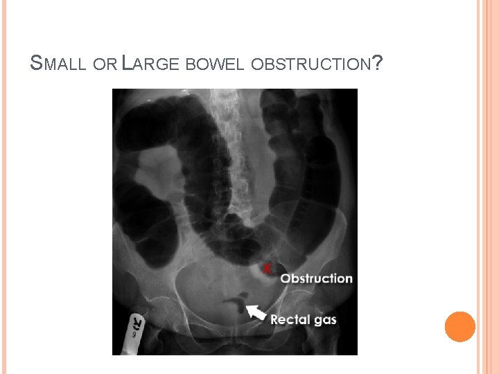 SMALL OR LARGE BOWEL OBSTRUCTION? 