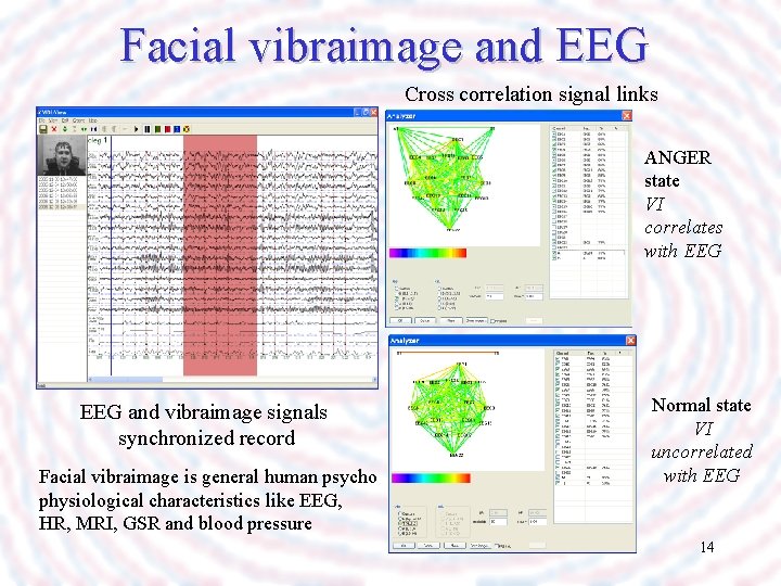 Facial vibraimage and EEG Cross correlation signal links ANGER state VI correlates with EEG