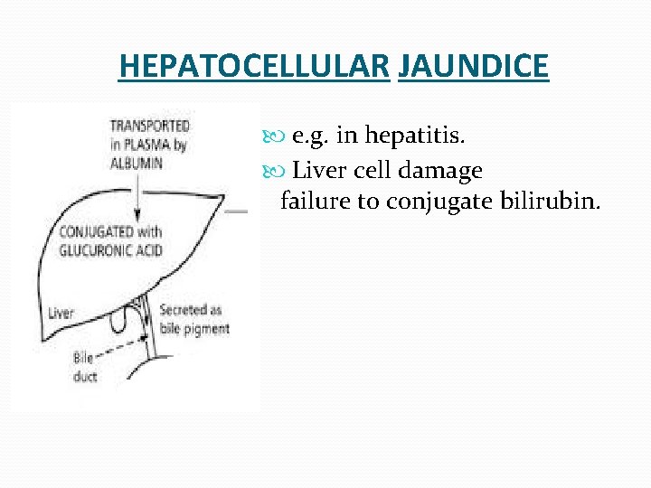 HEPATOCELLULAR JAUNDICE. e. g. in hepatitis. Liver cell damage failure to conjugate bilirubin. 