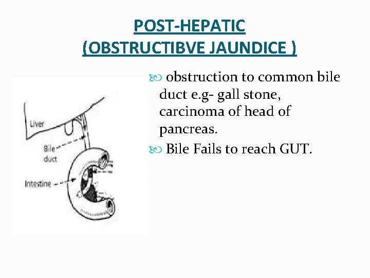 POST-HEPATIC (OBSTRUCTIBVE JAUNDICE ). obstruction to common bile duct e. g- gall stone, carcinoma