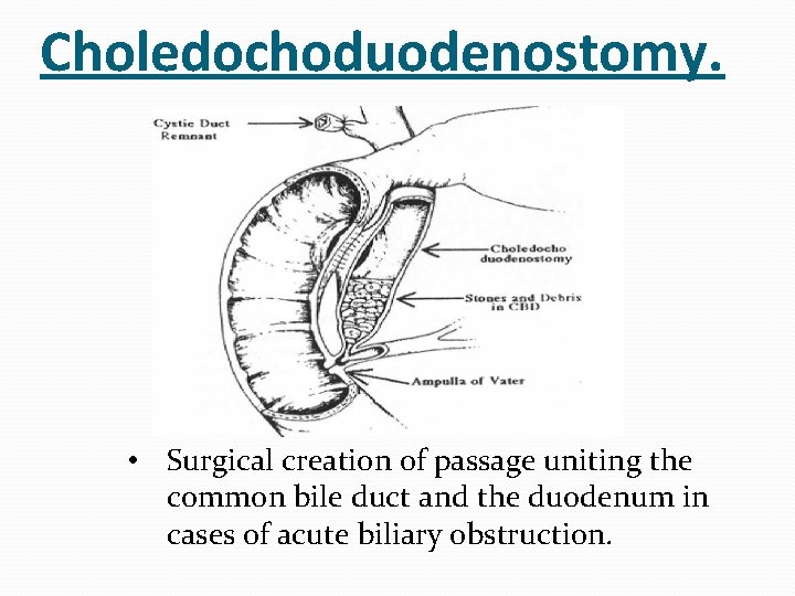 Choledochoduodenostomy. • Surgical creation of passage uniting the common bile duct and the duodenum