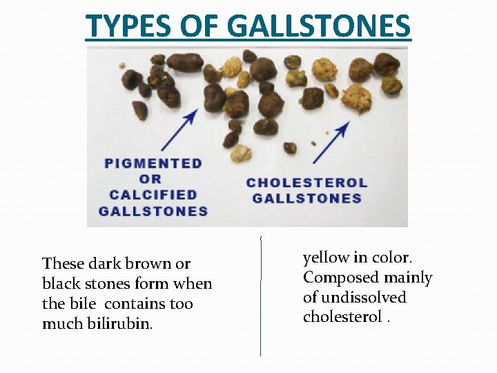 TYPES OF GALLSTONES These dark brown or black stones form when the bile contains