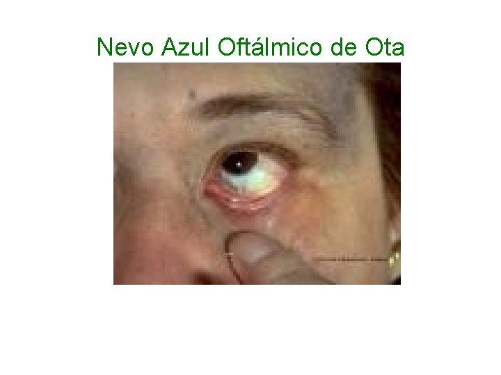 Nevo Azul Oftálmico de Ota 