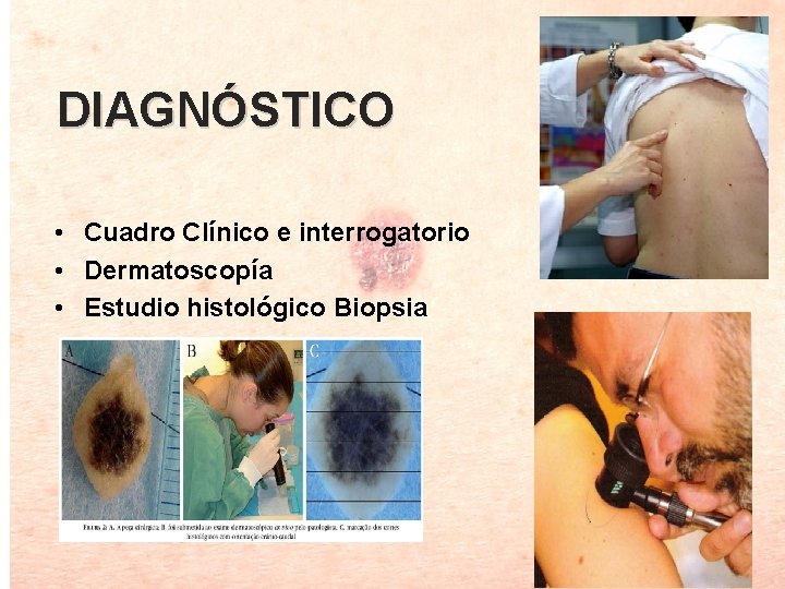 DIAGNÓSTICO • Cuadro Clínico e interrogatorio • Dermatoscopía • Estudio histológico Biopsia 