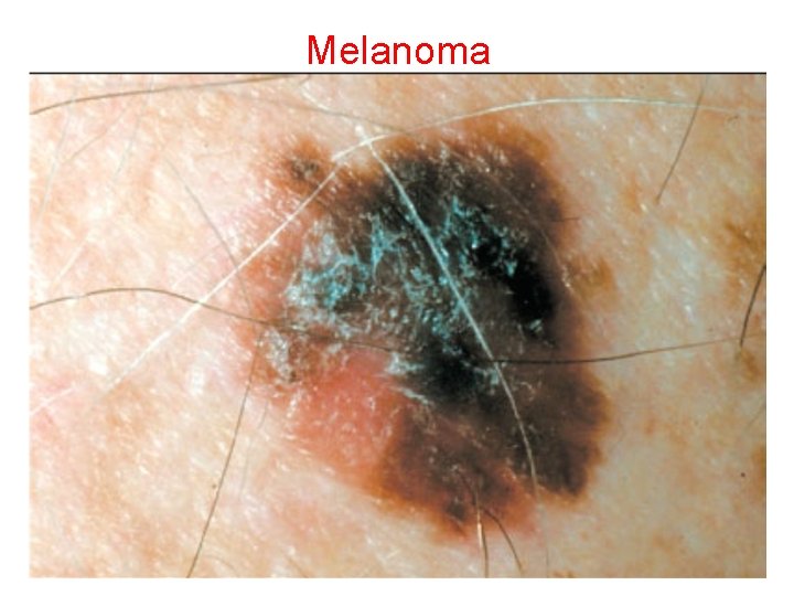 Melanoma 