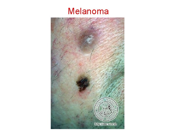 Melanoma 