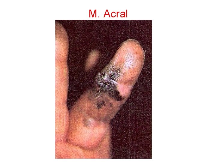 M. Acral 