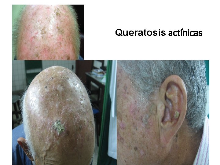 Queratosis actínicas 