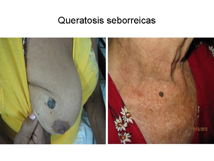 Queratosis seborreicas 