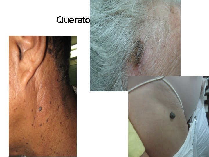 Queratosis seborreicas 