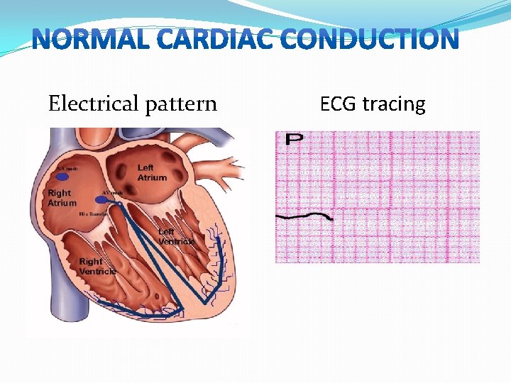 Electrical pattern ECG tracing 
