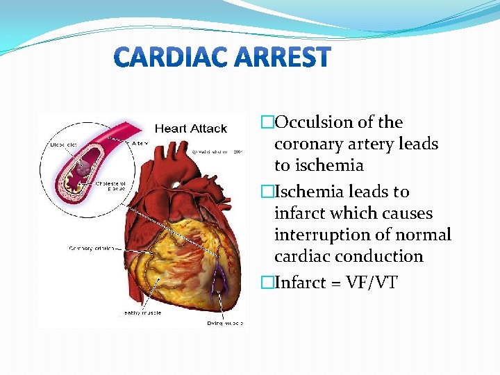 �Occulsion of the coronary artery leads to ischemia �Ischemia leads to infarct which causes